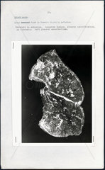 Post-mortem photograph of diseased lung  c 1973.