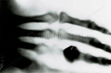 Roentgen's X-ray photograph  1895.