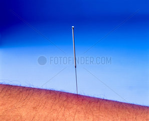 An acupuncture needle in use  2000.
