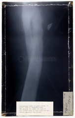 X-ray plate  1919.