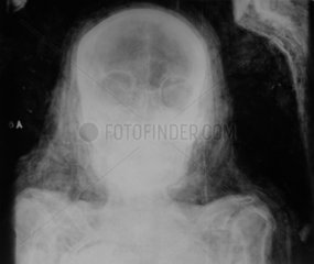 X-Ray of mummy's skull  22 january 1969.