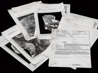 Selection of post-mortem reports of death from lung disease  c 1965.