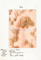 A crust skin disease  25 March 1902.
