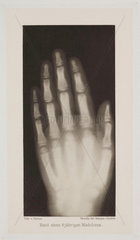 Hand of an 8 year-old girl  1896.