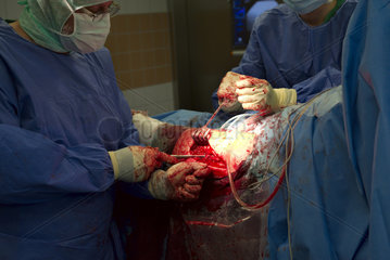 Chirurgen bei Hueft-Prothesen-Operation