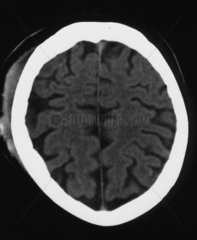 Magnetresonanztomographie MRT von einem Kopf