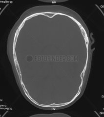 Magnetresonanztomographie MRT von einem Kopf