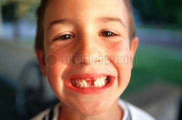 Junge mit Zahnluecke