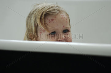 Girl with chickenpox taking a bath