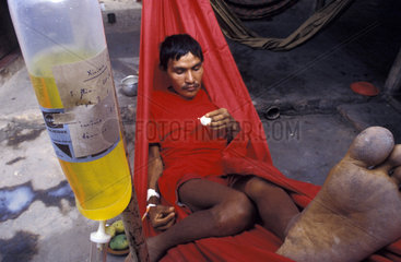 Amazon  Brazil. Indigenous People. Sick Ianomami ( Yanomami ) man with malaria rests in a hammock at Casa do Indio ( Hospital for the natives at Boa Vista city  in the state of Roraima  Brazil ). Diseases  sickness  ailments  bad health  infirmity  infirm