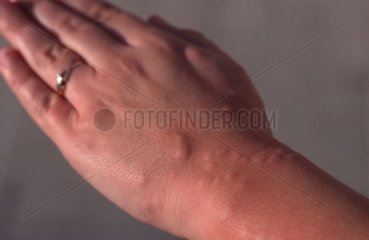 Résultats d'une attaque de moustiques sur une main