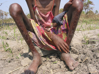 Closeup of a malnourished girls legs. Feeding centres and other humanitarian aid were organised in Angola after widescale malnutrition during and following the countrys civil war.
