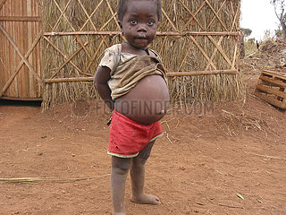 A severely malnourished child in Angola. Feeding centres and other humanitarian aid were organised in Angola after widescale malnutrition during and following the countrys civil war.