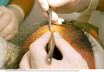 IMPLANT CHEVEU CHIRURGIE IMPLANT HAIR SURGERY