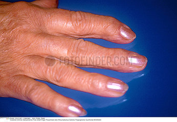 ARTHRITE MAIN ARTHRITIS HAND