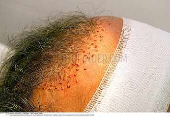 IMPLANT CHEVEU CHIRURGIE IMPLANT HAIR SURGERY