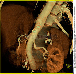 STENOSE ARTERE RENALE STENOSIS OF THE RENAL ARTERY