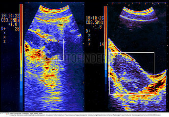 OVAIRE ECHOGRAPHIE OVARY  SONOGRAPHY