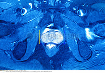 PROSTATE RMN RESULTAT PROSTATE  MRI