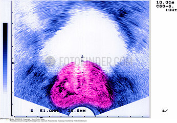 CANCER PROSTATE ECHOGRAPHIE CANCER OF THE PROSTATE SONOGRAPH