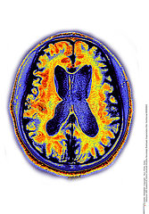 ALZHEIMER MALADIE IRM ALZHEIMER DISEASE  MRI