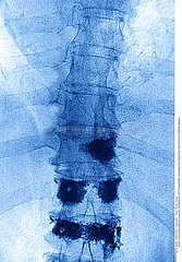 PAGET MALADIE RADIO PAGET'S DISEASE  X-RAY