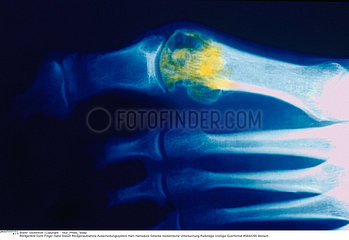 GOUTTE RADIO GOUT  X-RAY