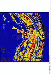 OSTEOPOROSE RMN OSTEOPOROSIS  MRI