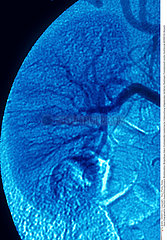 REIN ANGIOGRAPHIE RESULTAT KIDNEY  ANGIOGRAPHY RESULT