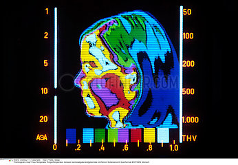 TETE THERMOGRAPHIE HEAD  THERMOGRAPHY
