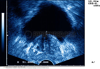 CANCER PROSTATE ECHOGRAPHIE CANCER OF THE PROSTATE SONOGRAPH