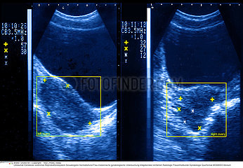 OVAIRE ECHOGRAPHIE OVARY  SONOGRAPHY