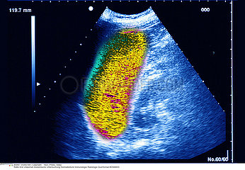 RATE ECHOGRAPHIE RATE  SONOGRAPHY
