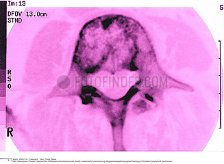 OSTEOPOROSE RMN!!OSTEOPOROSIS  MRI