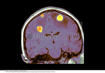 METASTASE CERVEAU IRM!!METASTASIS IN THE BRAIN  MRI