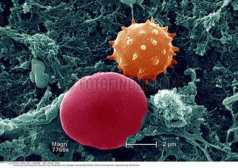 HEMATIE ACANTHOCYTE!!ACANTHOCYTE  RED BLOOD CELL