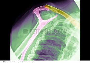 FRACTURE CLAVICULE RADIO!!FRACTURED COLLARBONE  X-RAY
