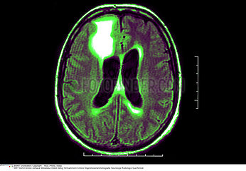 EPILEPSIE RMN!!EPILEPSY  MRI