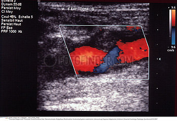 THROMBOSE VEINE ECHOGRAPHIE VENAL THROMBOSIS  SONOGRAPHY