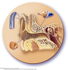 SURDITE PROTHESE!!HEARING AID