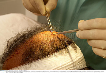 IMPLANT CHEVEU CHIRURGIE!!IMPLANT HAIR SURGERY