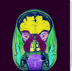 TETE RMN!!HEAD  MRI