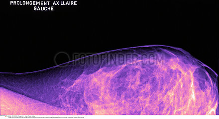 SEIN RADIOGRAPHIE!!BREAST  X-RAY