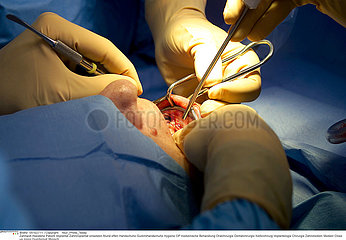 IMPLANT DENT CHIRURGIE!!IMPLANT TOOTH SURGERY