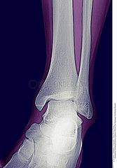 CHEVILLE RADIO!!ANKLE  X-RAY