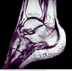 FRACTURE PIED!!FRACTURED FOOT