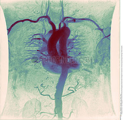 COEUR ANGIOGRAPHIE!!HEART  ANGIOGRAPHY