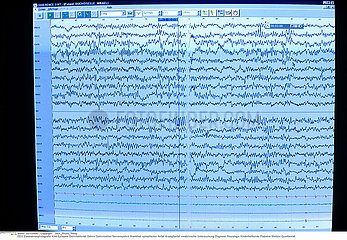 EPILEPSIE EEG!!EPILEPSY  EEG
