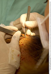 IMPLANT CHEVEU CHIRURGIE!!IMPLANT HAIR SURGERY
