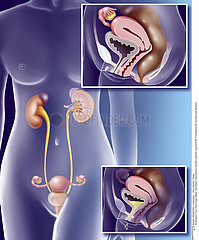 INCONTINENCE URINE FEMME!!WOMAN WITH INCONTINENCE OF URINE